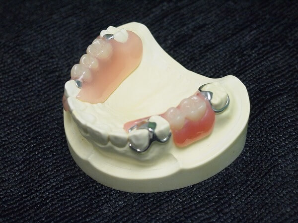 ノンクラスプデンチャーは健康な歯にダメージを与えない美しい入れ歯です。