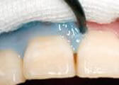 歯肉の保護とリップ塗布